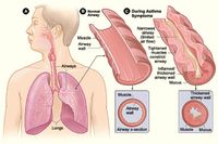 640px-Asthma_attack-illustration_NIH