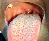 Strep_throat_with_white_strawberry_tongue